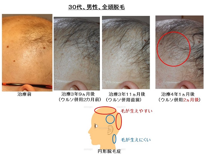 円形脱毛症　病院